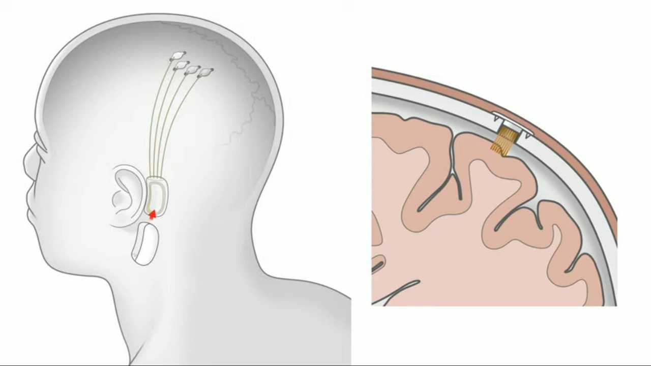 Elon Musk Presents Neuralink, A Revolutionary Brain Implant