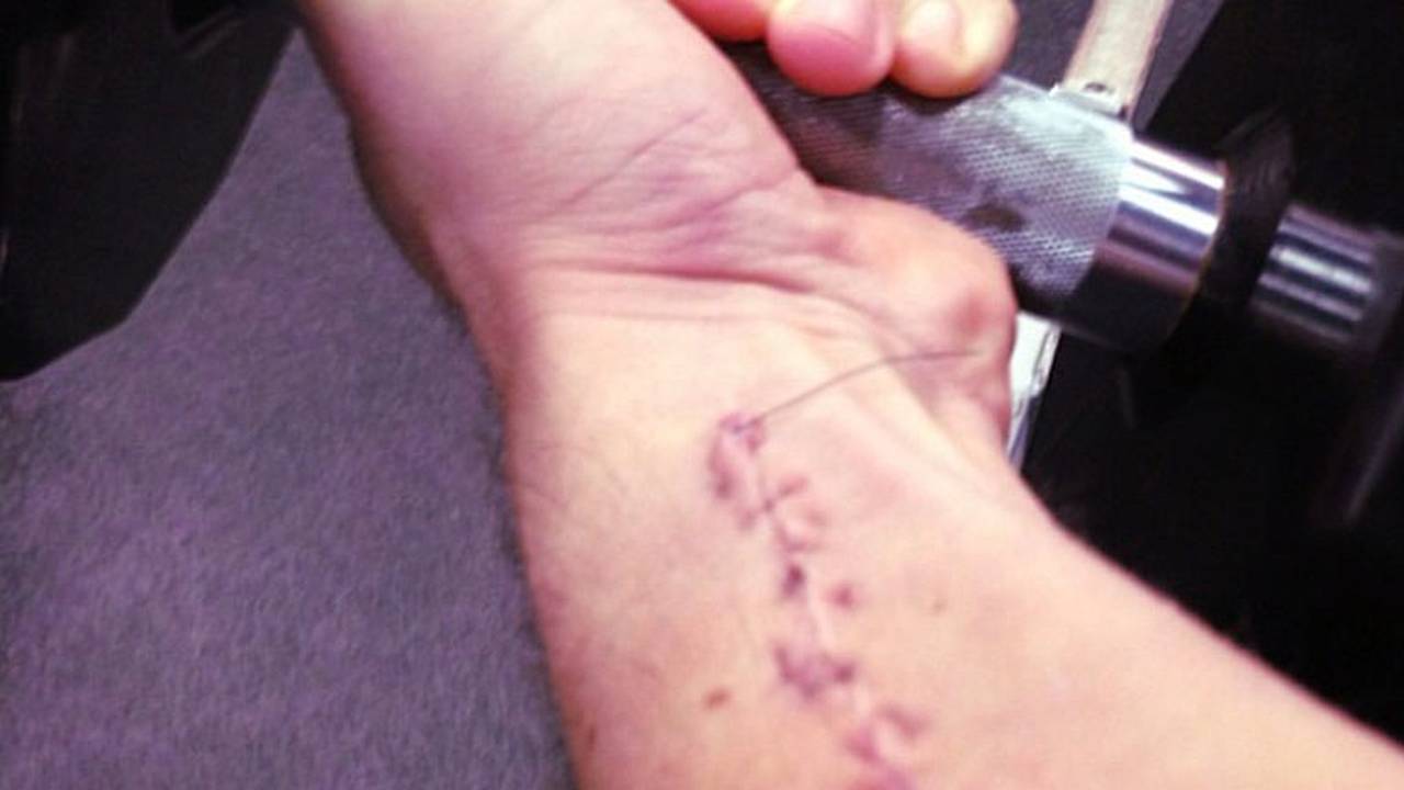 The scar that remains to this day.