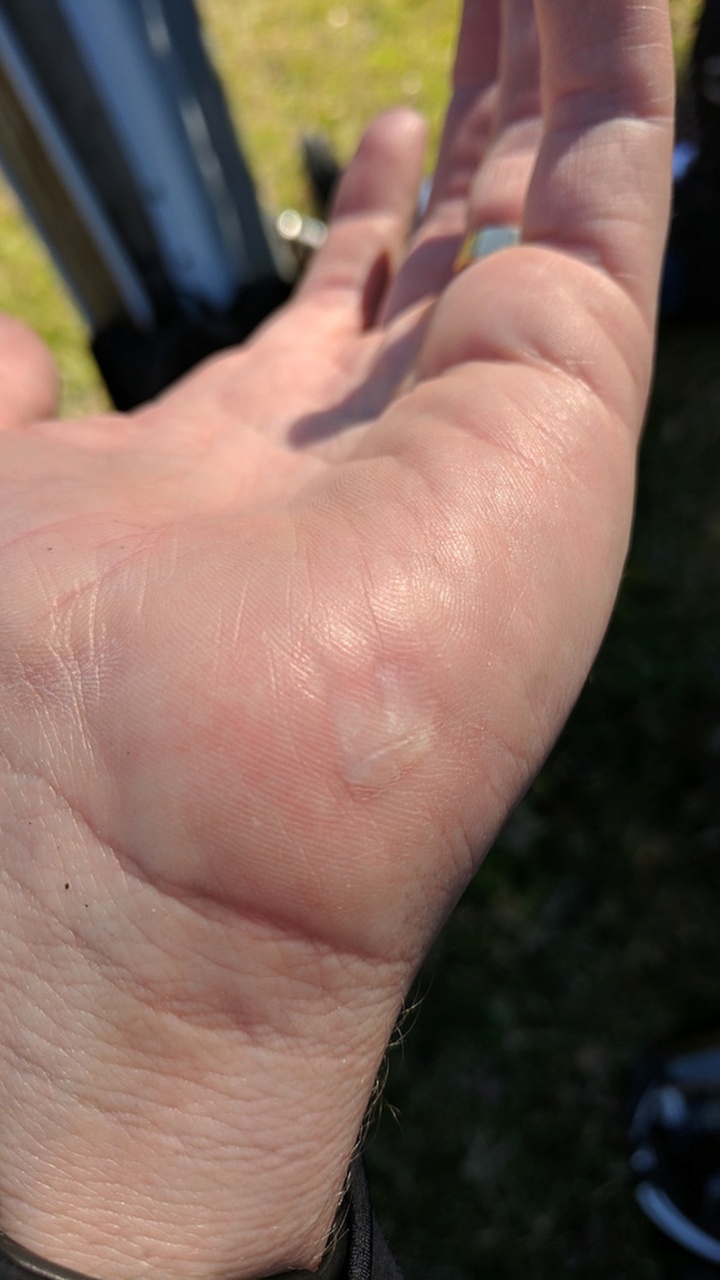 <em>I didn't lose any skin, thanks to decent gloves, but the heat of sliding caused a blister on my palm.</em>