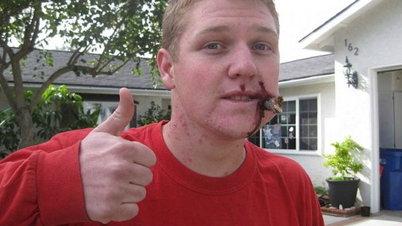 Impaled! the gnarliest bike injury you’ll see all day